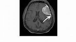 Meningioma- Helpful Imaging Signs #Shorts