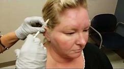 Botox for Migraines at Mercy