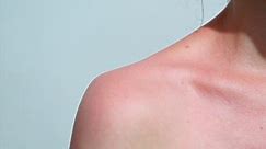 How to Treat a Sunburn