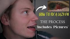 How To Fix A Lazy Eye | Strabismus Surgery | START to FINISH (Including Pictures) Lazy Eye Surgery