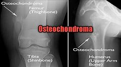 Osteochondroma , solitary and multiple pathology #oncology #cancer