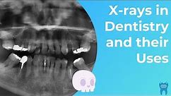 Types of Dental X-rays you NEED to know | Dental Radiographs and Why we use them