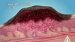 What are warts (HPV)? - 3D animation