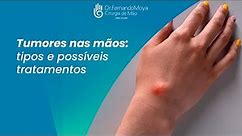 Tumores da Mão | Dr. Fernando Moya CRM 112046