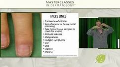 Nailing It: Update on Nail Disorders