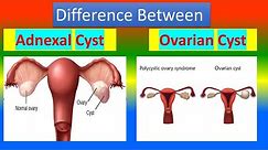 Difference Between Adnexal Cyst and Ovarian Cyst