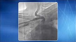 Chapter 14: TRA for addressing Subclavian & Innominate Artery Lesions