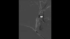 Nuances of carotid artery stenting under flow arrest with dual-balloon guide catheter