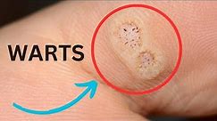GET RID OF WARTS: Here's How!