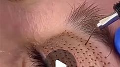 Zensa Skin Care on Instagram: "Watch the intricate process of a plasma eye lift by the talented @sknhance.⁠ ⁠ Plasma fibroblast is a non-surgical, anti-aging and preventative-aging treatment that renews the skin by tightening loose skin or wrinkles, lifting hooded eyelids, improving skin texture and brightening under eyes. ⁠ ⁠ Apply Zensa Numbing Cream prior to this procedure for a painless experience with visibly rejuvenated skin. ✨️"