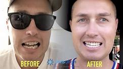 Invisalign Review | Invisalign Before And After