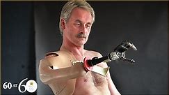 1993: First Bionic Arm