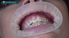 Clear Braces - Watch how they are put on