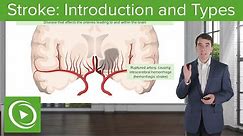 Stroke: Introduction and Types | Clinical Neurology
