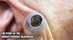 World's Biggest Blackhead - The True Story