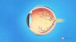 What causes a retinal tear or detachment?