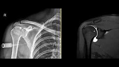 What is an MRI shoulder arthrogram?