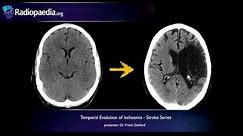 Stroke: Evolution from acute to chronic infarction - radiology video tutorial (CT, MRI)