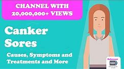 Canker Sores - Causes, Symptoms and Treatments and More