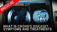 What is Crohn's disease? Symptoms and treatments