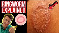Doctor explains Ringworm (aka Tinea) including symptoms, signs, causes and treatment!