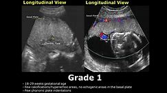 Placental Ultrasound Pathologies, Grading & Positions USG | Pregnancy USG