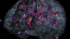 brain fold n lesion