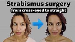 Strabismus surgery: Fixing my crossed eyes and vision