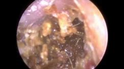 Huge Ear POLYP discovered after Ear Wax Removal - Mr Neel Raithatha (The Hear Clinic)
