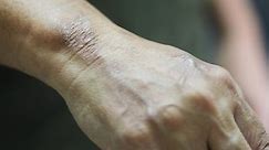 Florida becomes hotspot for leprosy, CDC says
