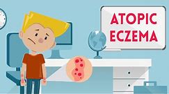 Atopic Eczema