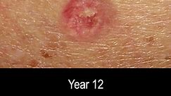 Basal Cell Carcinoma Skin Cancer Development Time Lapse (Normal to Cancer Over 25 Years)