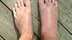 SPRAINED or BROKEN Ankle? : *Doctor Guide!*