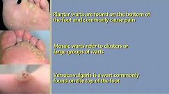What are Foot Warts and How To Treat Them