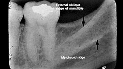 Dental Radiographic Anatomy