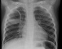Image result for posttraumatische Pneumatocele Im Ligamentum Pulmonale Inferior. Size: 126 x 100. Source: radiopaedia.org
