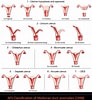 Image result for Uterus Didelphys. Size: 92 x 100. Source: www.researchgate.net