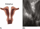 Image result for Uterus Didelphys. Size: 136 x 100. Source: bmp-e.blogspot.com