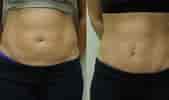 Before and After Tummy Tuck Abdominoplasty-साठीचा प्रतिमा निकाल. आकार: 169 x 100. स्रोत: cosmeticsurgerytips.com