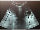 Image result for Uterus Didelphys. Size: 135 x 100. Source: bmp-e.blogspot.com