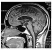 Image result for Corpus Callosum Mrt. Size: 104 x 100. Source: www.researchgate.net