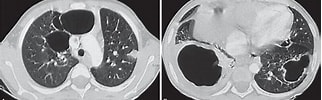 Image result for posttraumatische Pneumatocele Im Ligamentum Pulmonale Inferior. Size: 322 x 100. Source: www.jaypeedigital.com