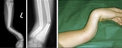 Schaftfraktur im Unterarm に対する画像結果.サイズ: 251 x 100。ソース: www.mysurgery.de