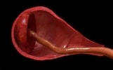 "spongosorites Placenta"-साठीचा प्रतिमा निकाल. आकार: 161 x 100. स्रोत: www.netmums.com