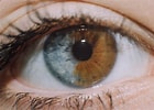 Image result for "heterochromia Rubra". Size: 140 x 100. Source: kmu.id