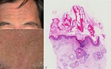 Afbeeldingsresultaten voor Lichen spinulosus Histology. Grootte: 161 x 100. Bron: www.researchgate.net