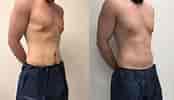 Before and After Tummy Tuck Surgery ਲਈ ਪ੍ਰਤੀਬਿੰਬ ਨਤੀਜਾ. ਆਕਾਰ: 174 x 100. ਸਰੋਤ: www.reneeburkemd.com