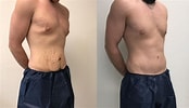 تصویر کا نتیجہ برائے Before and After Tummy Tuck Surgery. سائز: 174 x 100۔ ماخذ: www.reneeburkemd.com