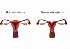 Image result for uterus bicornis bicollis. Size: 141 x 100. Source: parenting.firstcry.com
