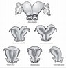 Image result for uterus bicornis bicollis. Size: 96 x 100. Source: radiologykey.com